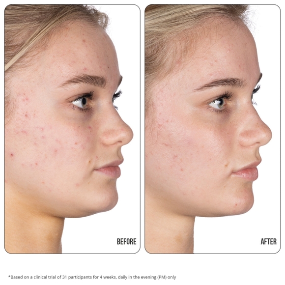 NIB! NIP+ FAB RENEW Blemish gel treatment - Picture 5 of 6